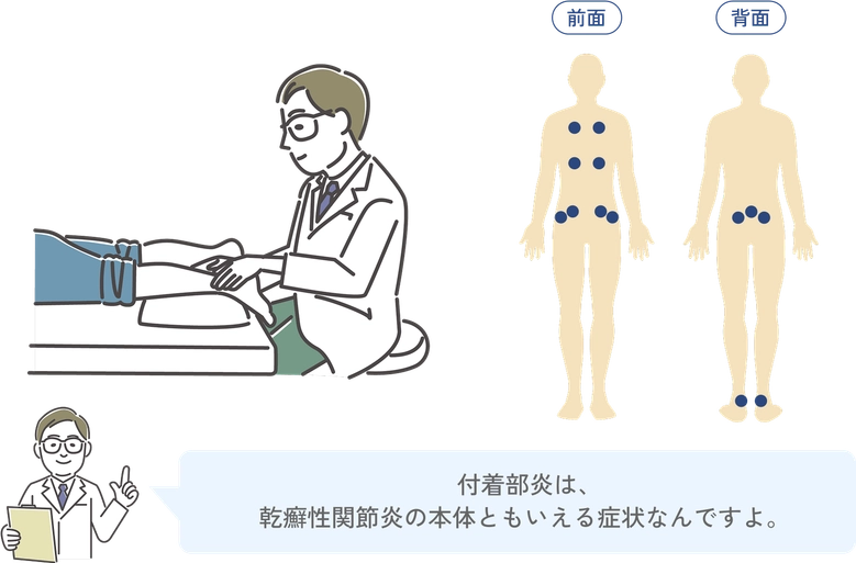 医師が付着部を診察する様子と、身体前面・背面における代表的な付着部位を示した図。付着部炎は乾癬性関節炎の特徴的症状で、MDA評価にも用いられる。
