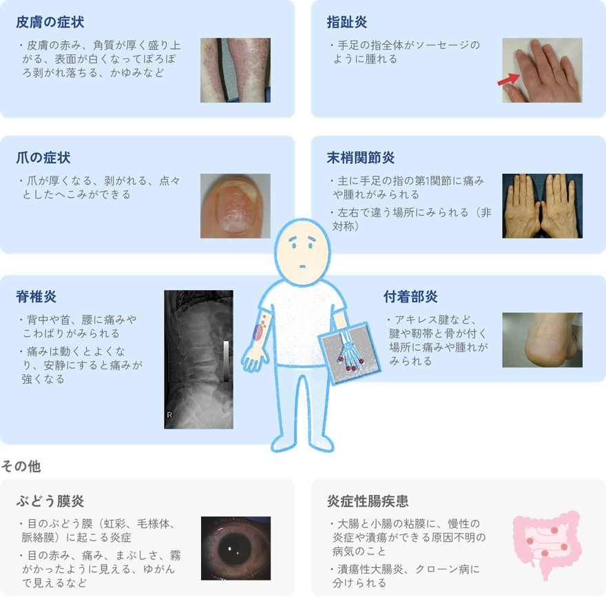 乾癬性関節炎に見られる多様な症状を示す図。皮膚や爪、末梢関節、脊椎の炎症に加え、ぶどう膜炎や炎症性腸疾患など全身に及ぶ特徴がまとめられている。